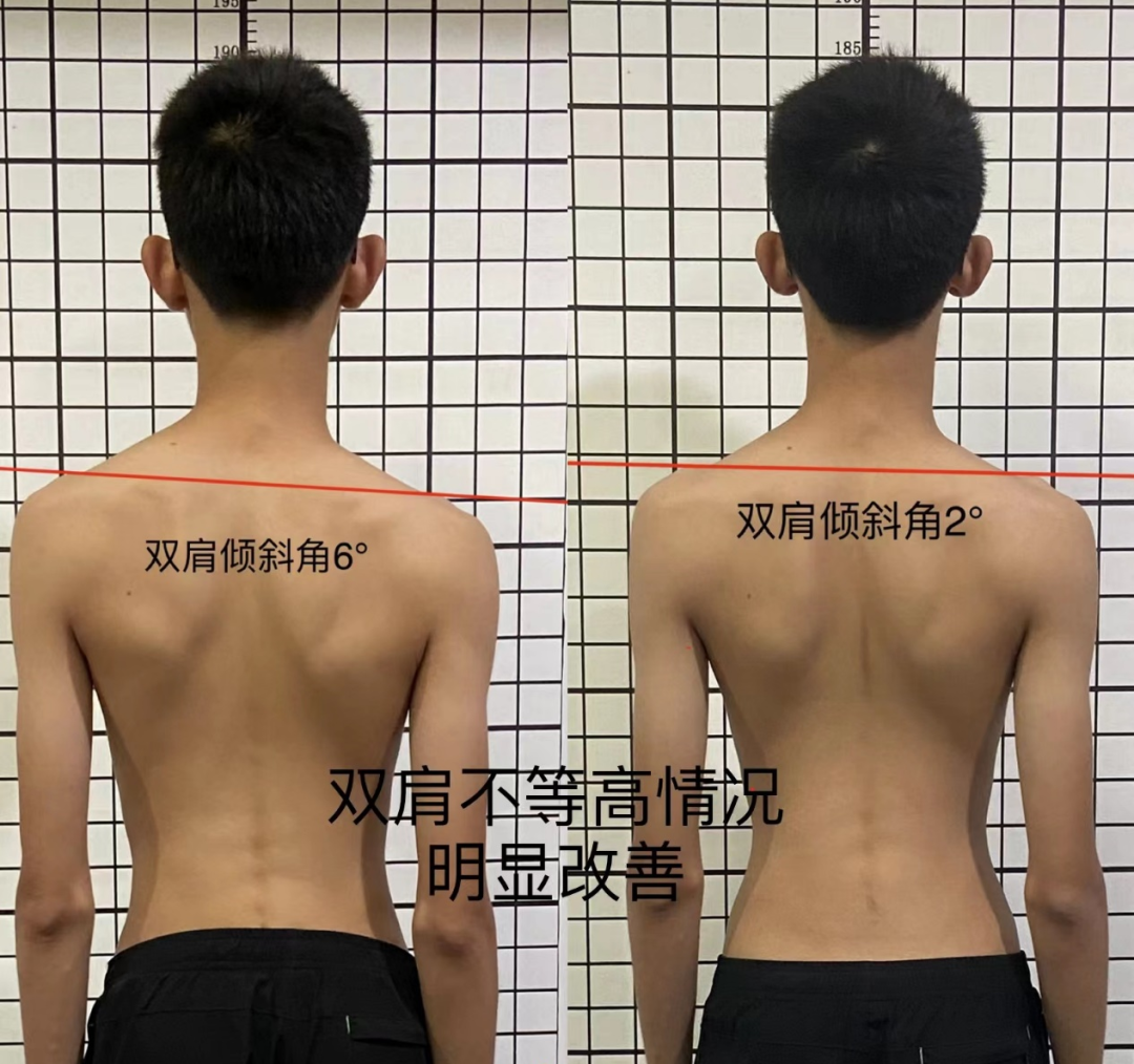 浙江康復醫院：了解青少年脊柱側彎，及早發現治療