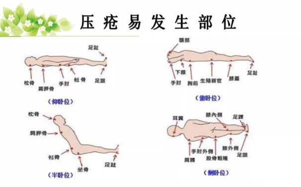 杭州壓瘡醫院科普--該如何預防臥床老人壓瘡的發生呢?請您跟我這樣做